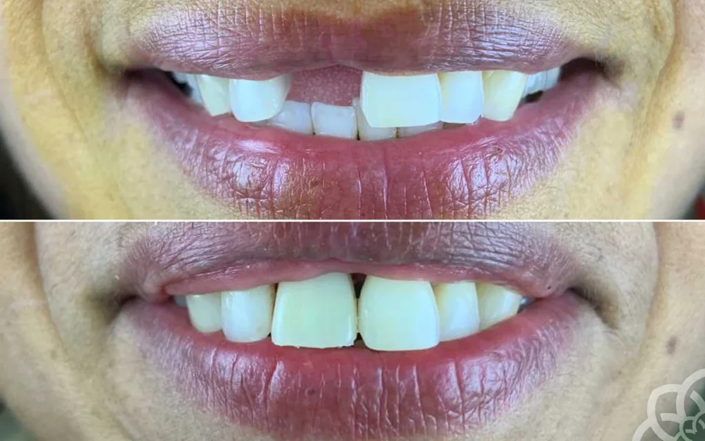 Caso real de um paciente sem um dente da frente e posteriormente com uma coroa dentária implantada