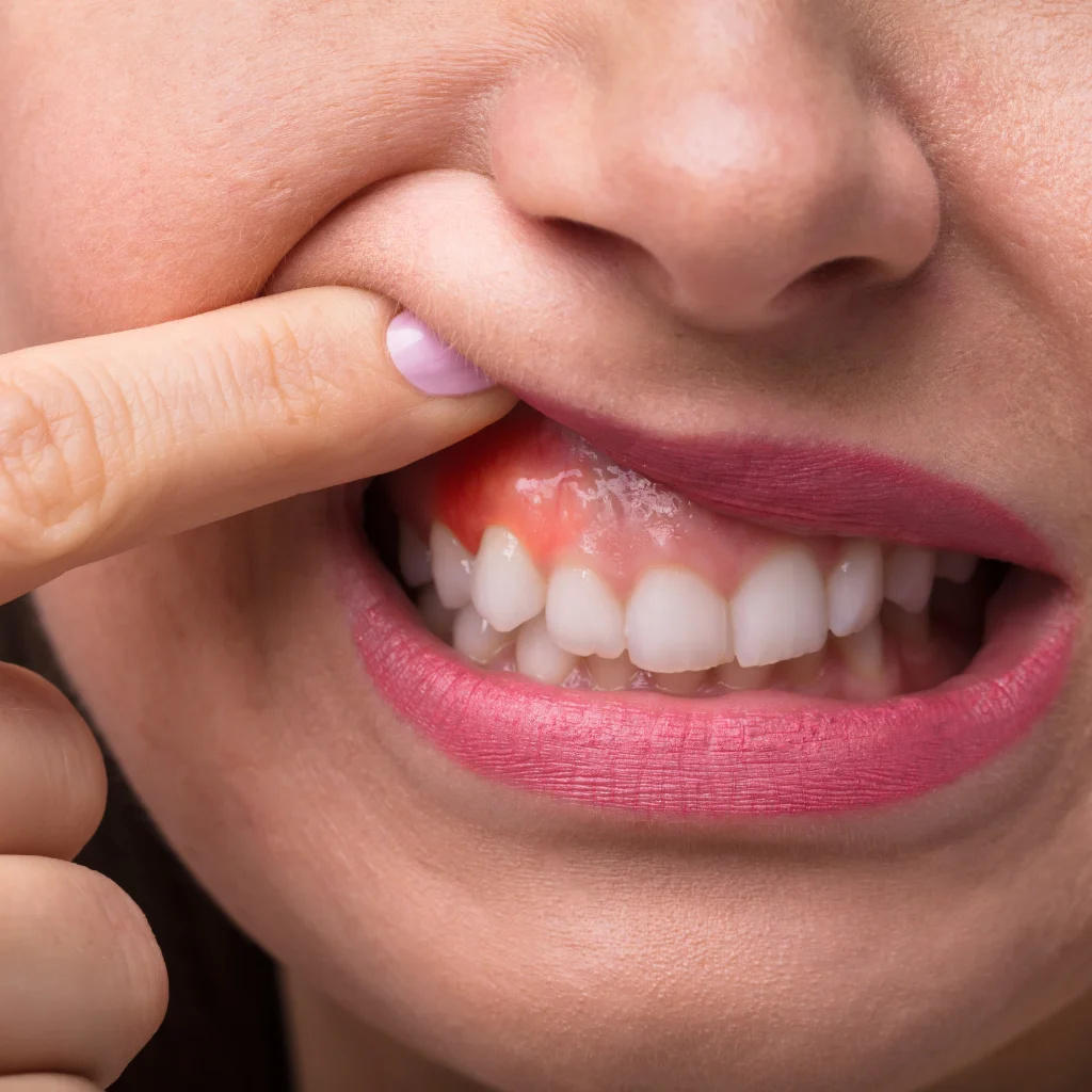 A inflamação das gengivas é um dos problemas tratados pela periodontologia