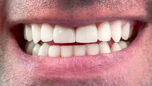 Resultado da colocação de facetas dentárias