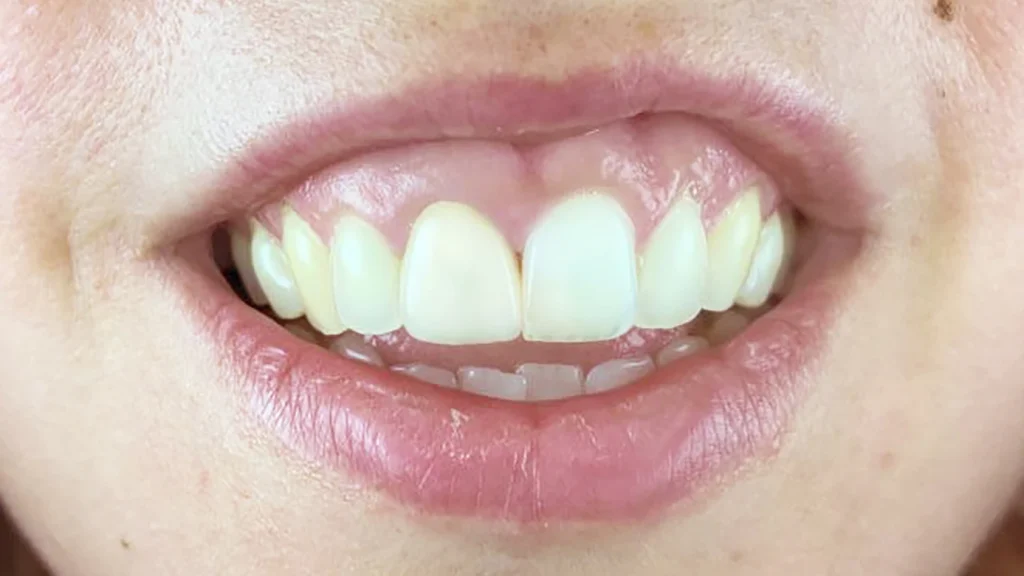 Resultado da colocação de faceta dentária