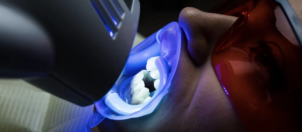 Mitos sobre o branqueamento dentário intervenção luz LED