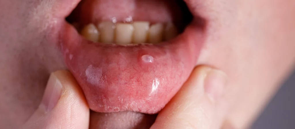 cancro oral labial