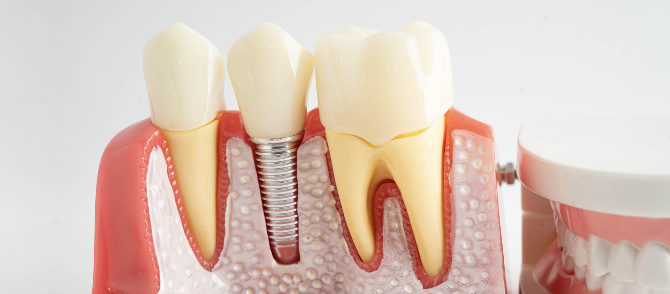 Quanto tempo dura um implante dentário?