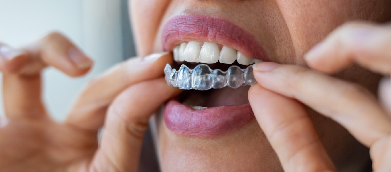aparelho dentário com implante
