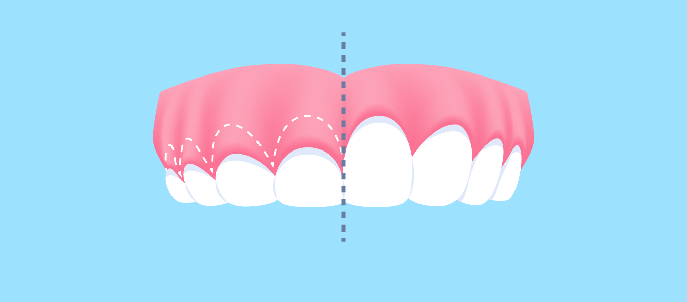 gengivectomy recovery