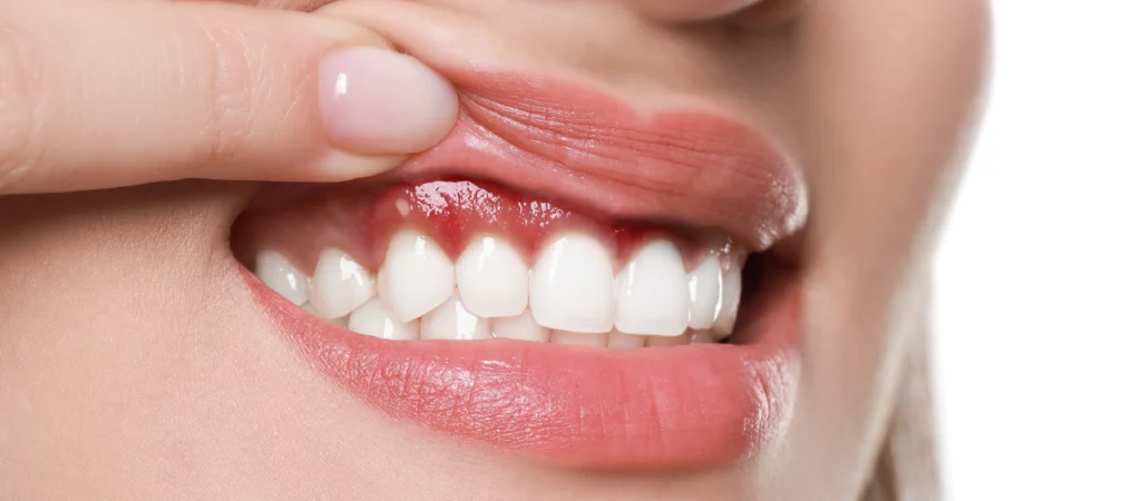 periodontite e saúde geral