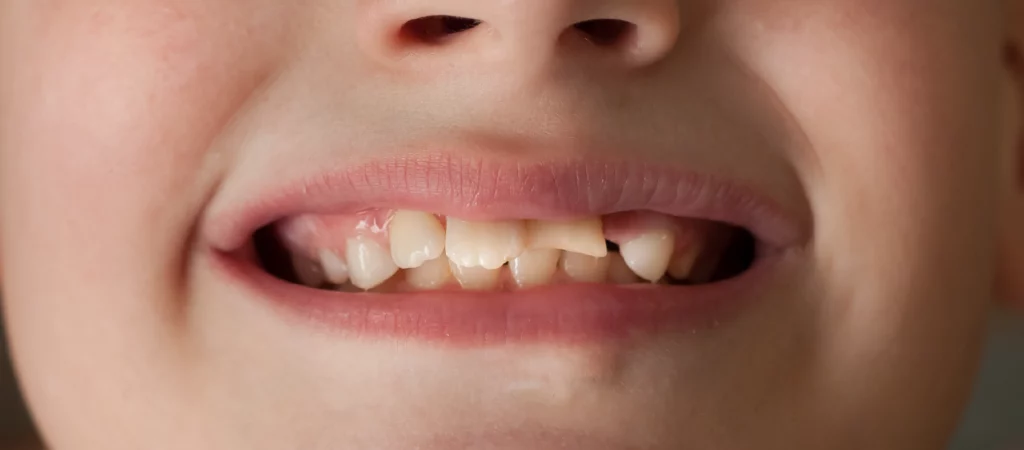 child broke a tooth