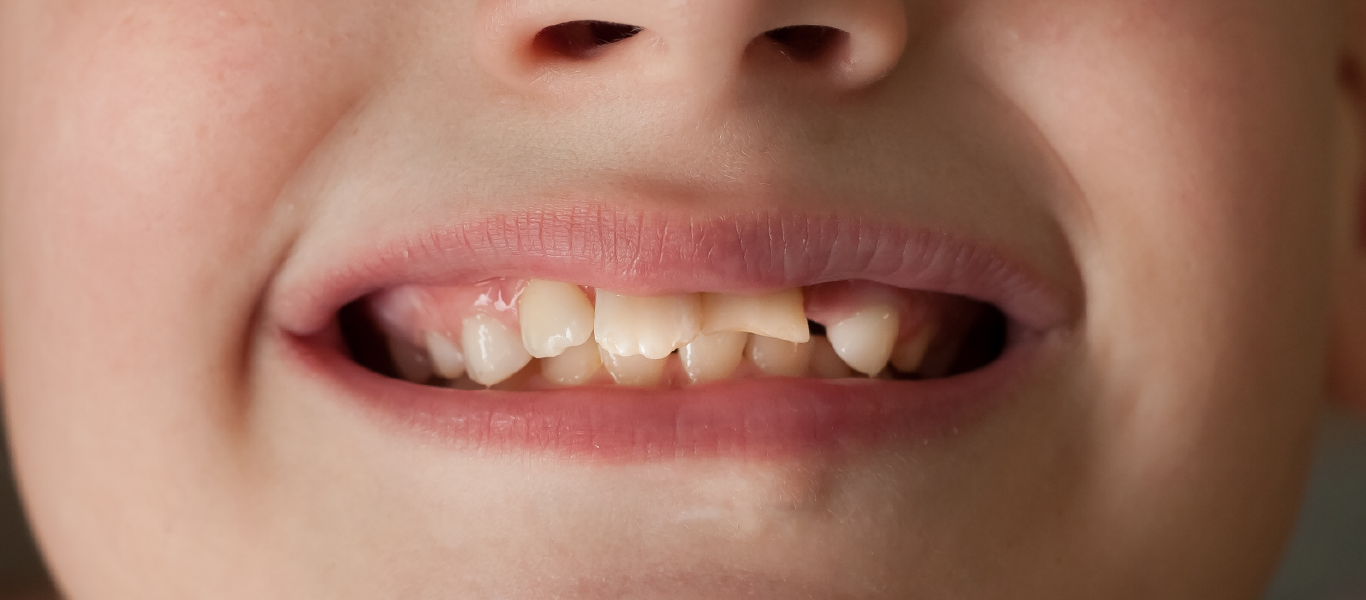 child broke a tooth