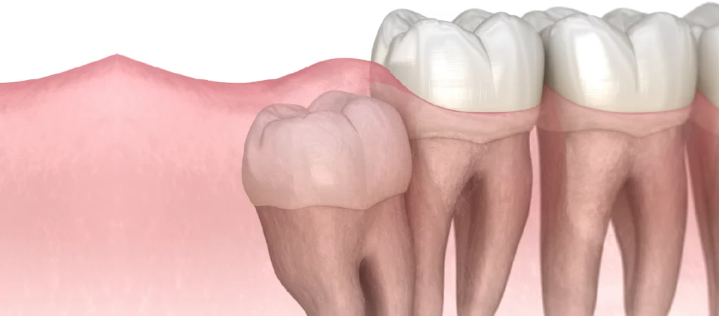 remoção de dente incluso
