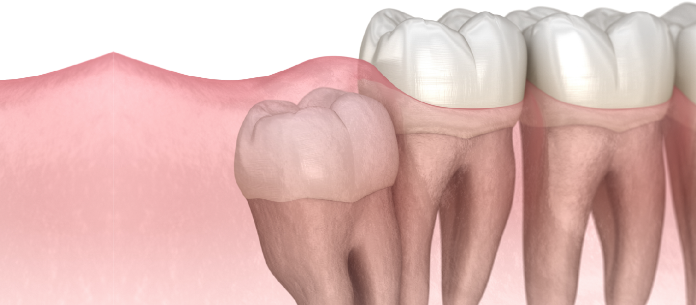 tooth removal included