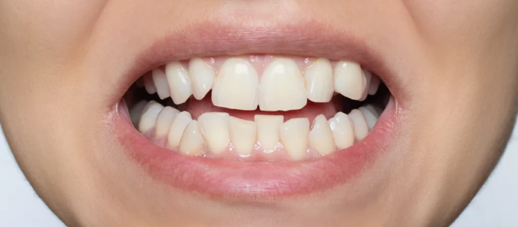 Como escolher um aparelho dentário