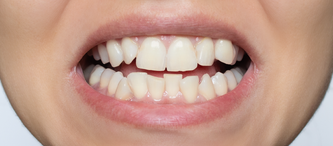 Como escolher um aparelho dentário