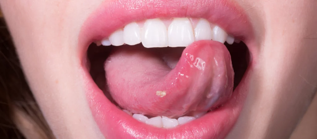 VPH dans la bouche