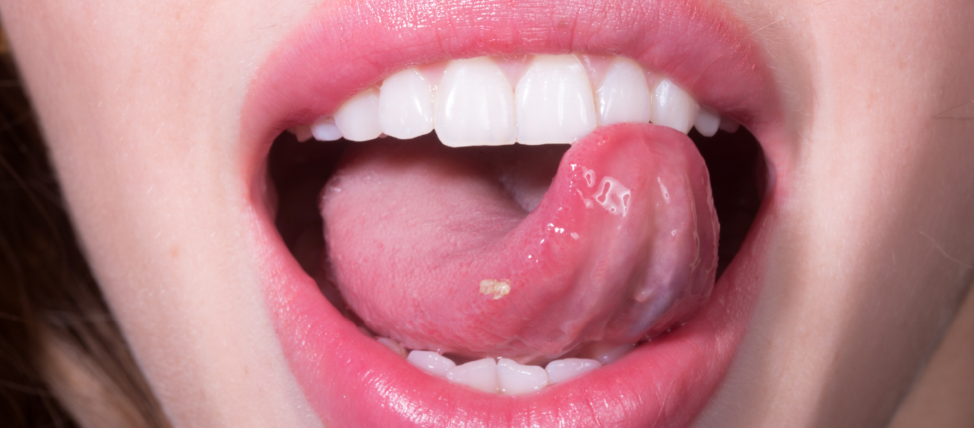 HPV in the mouth