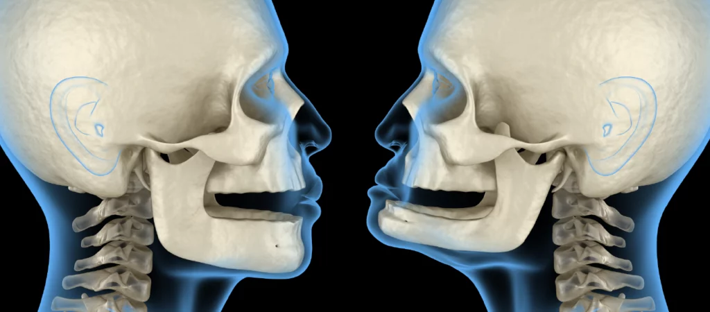 falta de dentes envelhece o rosto: ilustração 3D do crânio e do contorno facial