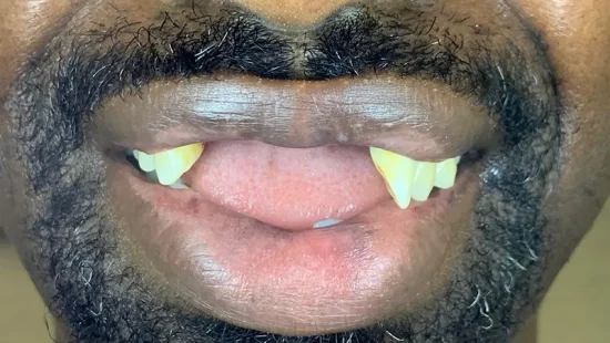 antes-caso12-protese-fixa-cirurgia-implantes